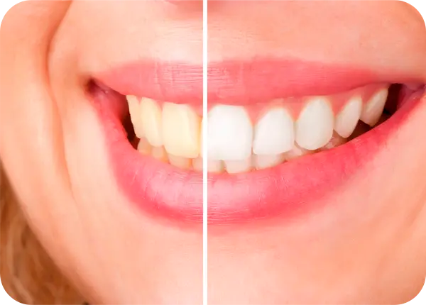 Blanqueamiento dental