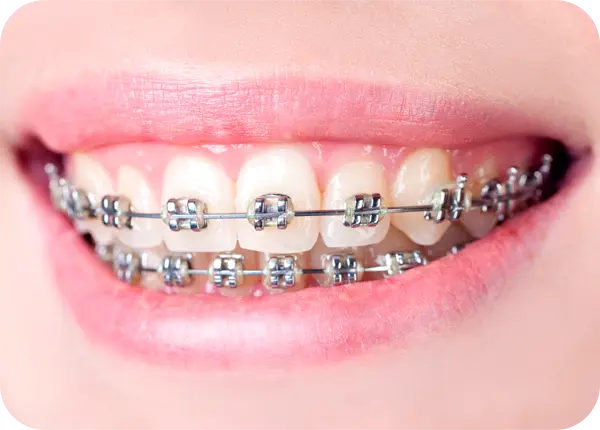 Brackets en Guatemala